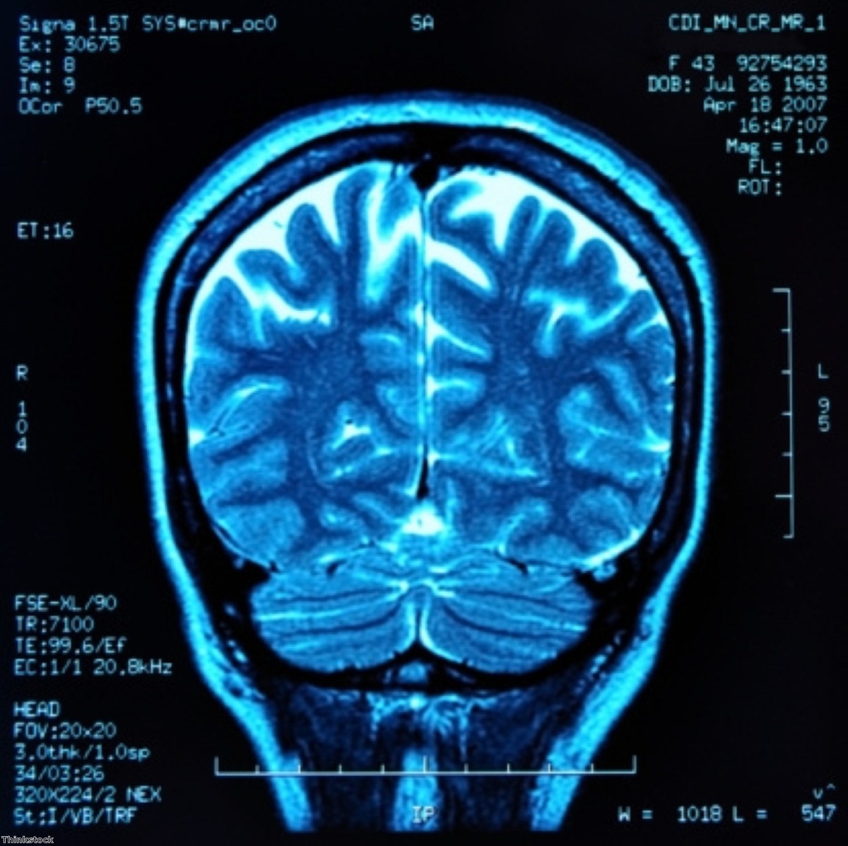 Carbon monoxide 'could protect against Alzheimer's' Carbon monoxide 'could protect against Alzheimer's'