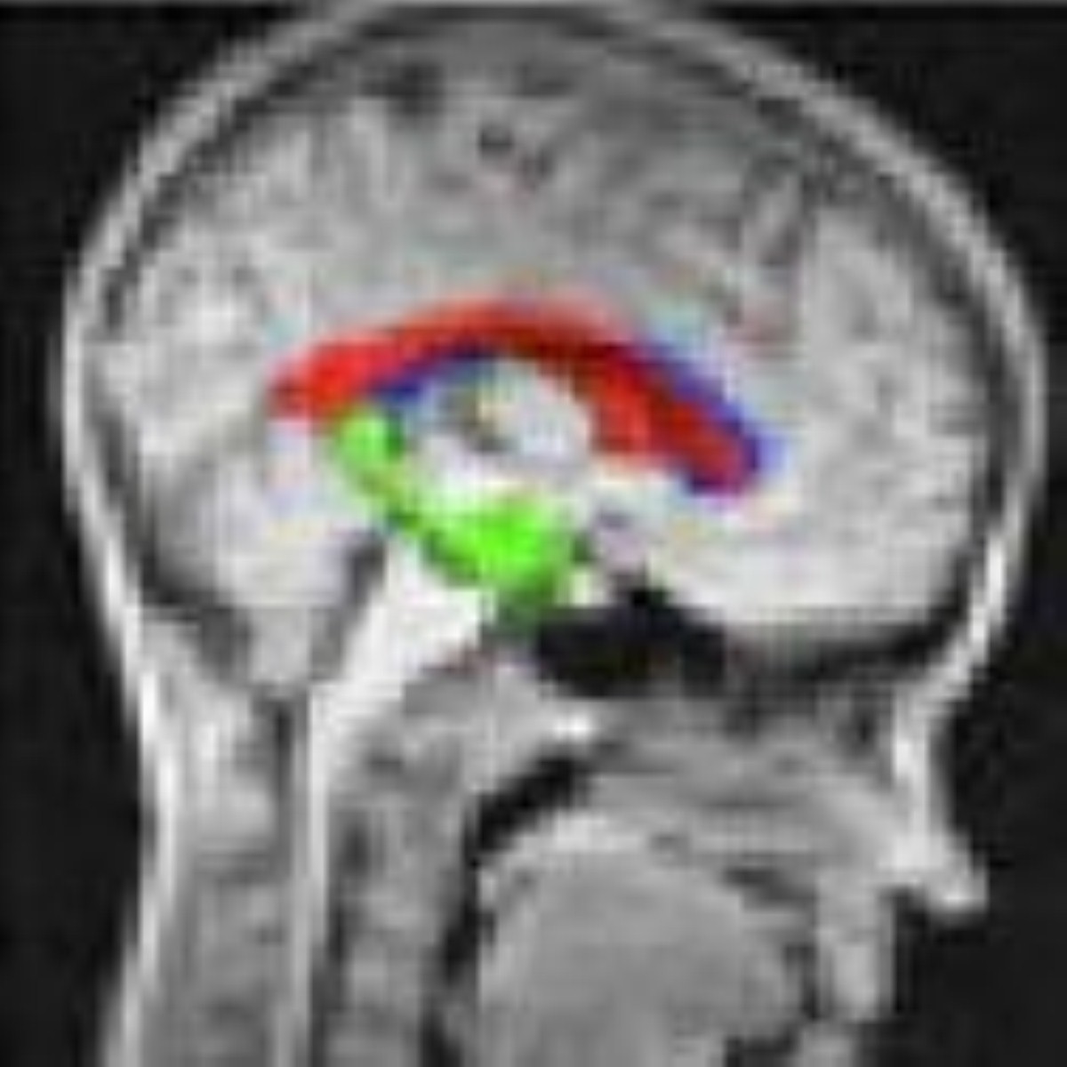 Brain imaging reveals drug treatments for Parkinson's disease Brain imaging reveals drug treatments for Parkinson's disease