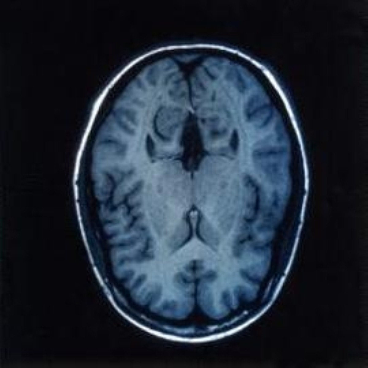 Chemical messenger production affected by brain parasite Chemical messenger production affected by brain parasite