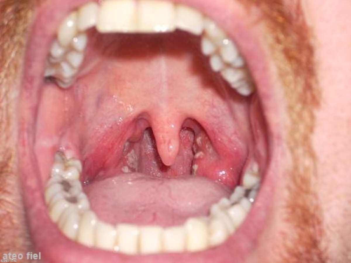 back-of-throat-cancer-doctorvisit
