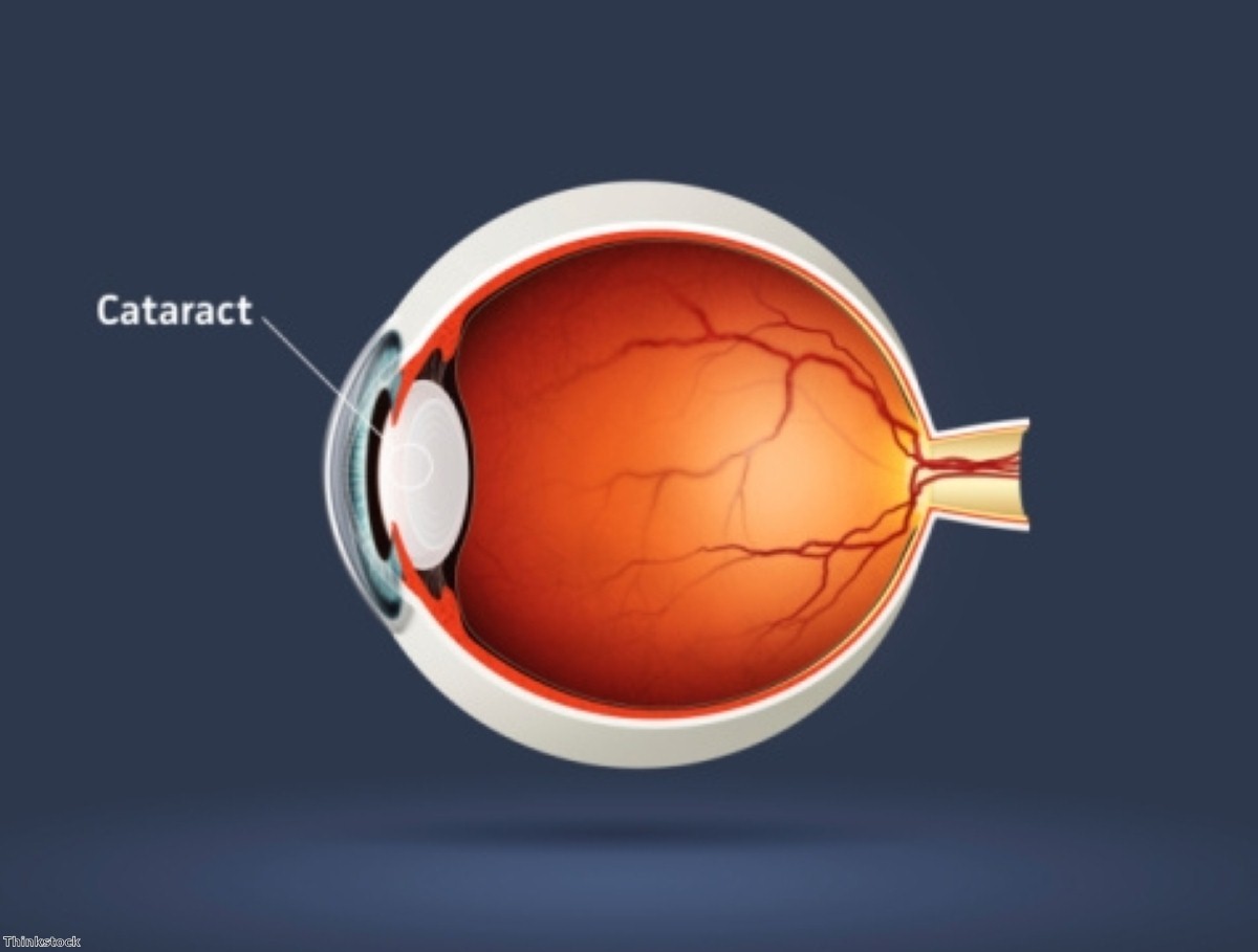 Could your cataracts be a sign of Alzheimer's disease? Could your cataracts be a sign of Alzheimer's disease?