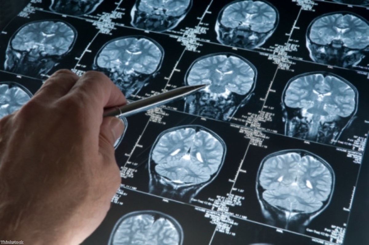 "Minimally invasive" Parkinson's implant developed "Minimally invasive" Parkinson's implant developed