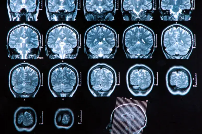 Brain scanner 'to help dementia fight'