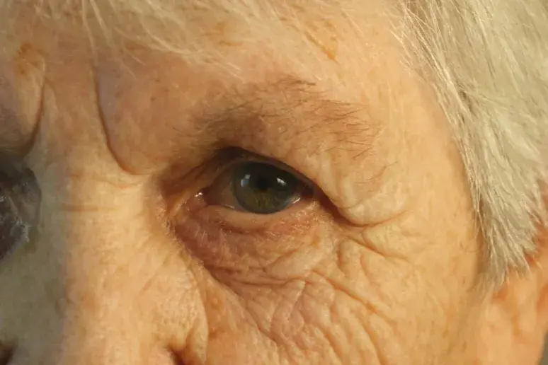New test could help prevent vision loss after cataract surgery