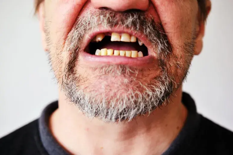 Tooth loss could be warning sign for early death