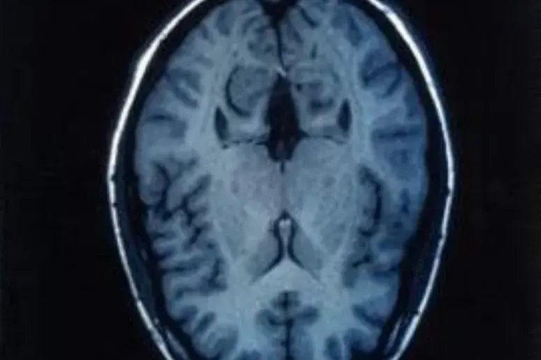 New brain scan to better understand Alzheimer's?