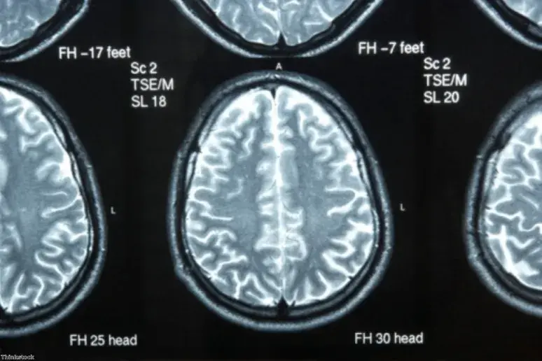 Traumatic brain injury risk factor for Parkinson's?