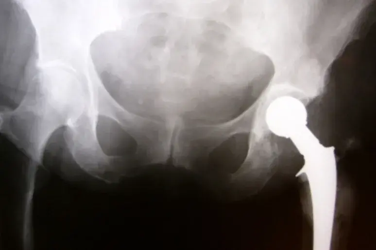 Failure documentation offers tips for hip replacement
