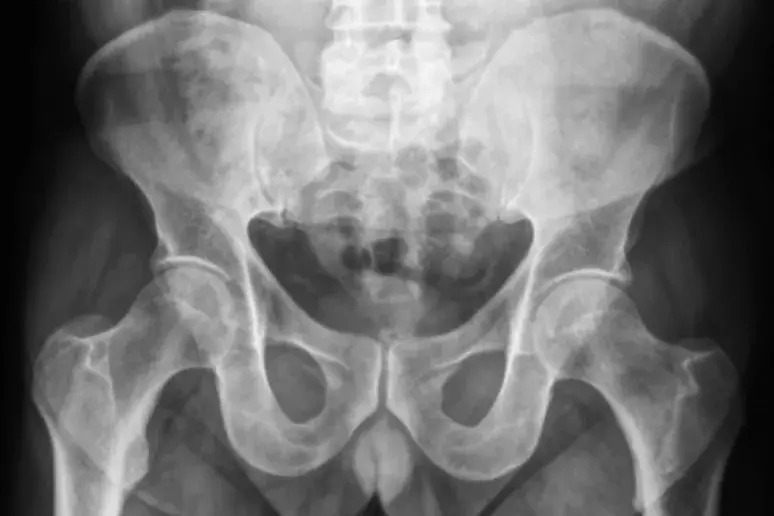 Regional anesthesia lowers risk in hip fracture patients