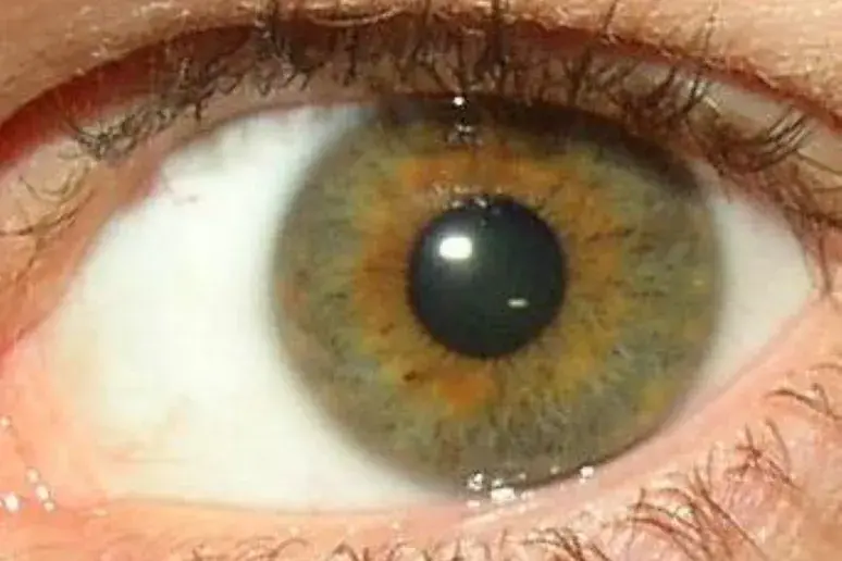 Eye test 'can measure decline' in MS patients